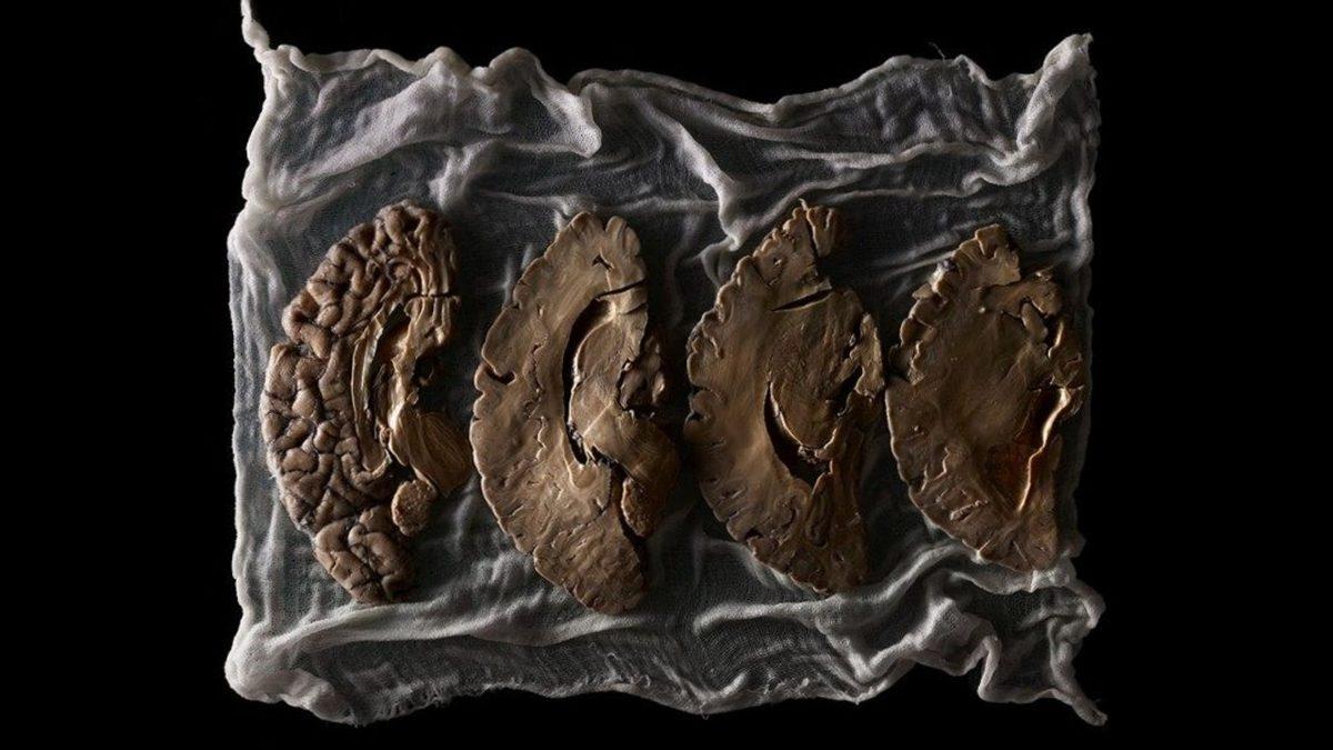 Akıl Hastalarının Birbirinden Çok Farklı Görünen Beyinleri: Kıvrımsız Olanı Bile Var!