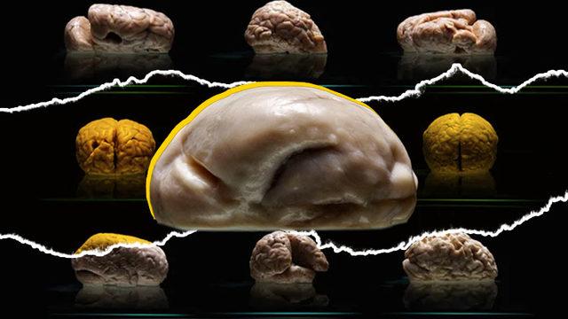 Akıl Hastalarının Birbirinden Çok Farklı Görünen Beyinleri: Kıvrımsız Olanı Bile Var!
