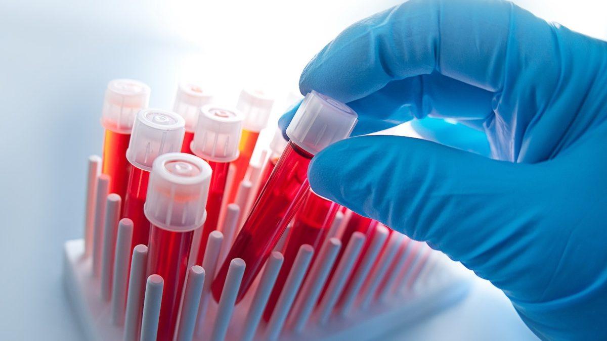 Kan Tahlilinde Vücudumuzun İltihap Yoğunluğunu Gösteren ’CRP’ Nedir, Düşüklüğü ve Yüksekliği Ne Anlama Gelir?