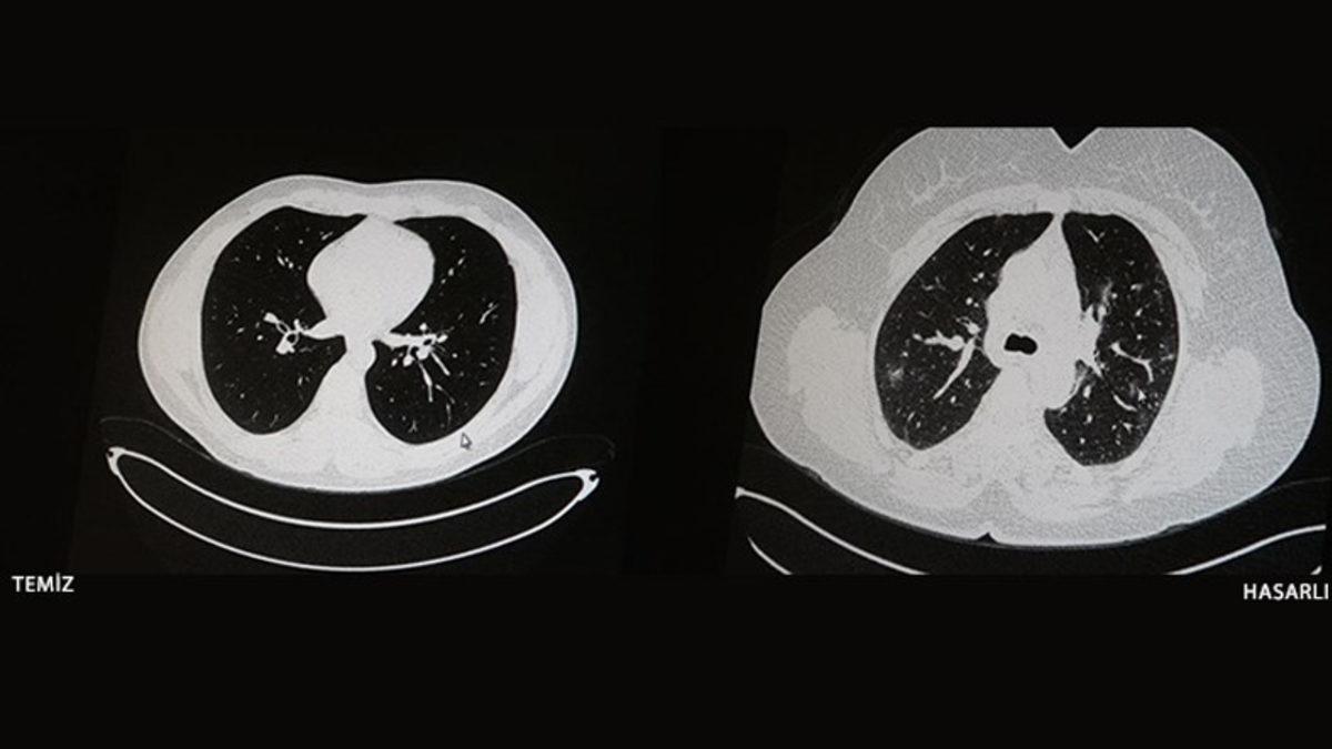 Aşı Olan ve Olmayan COVID-19 Hastalarının İbretlik Tomografi Görüntüleri