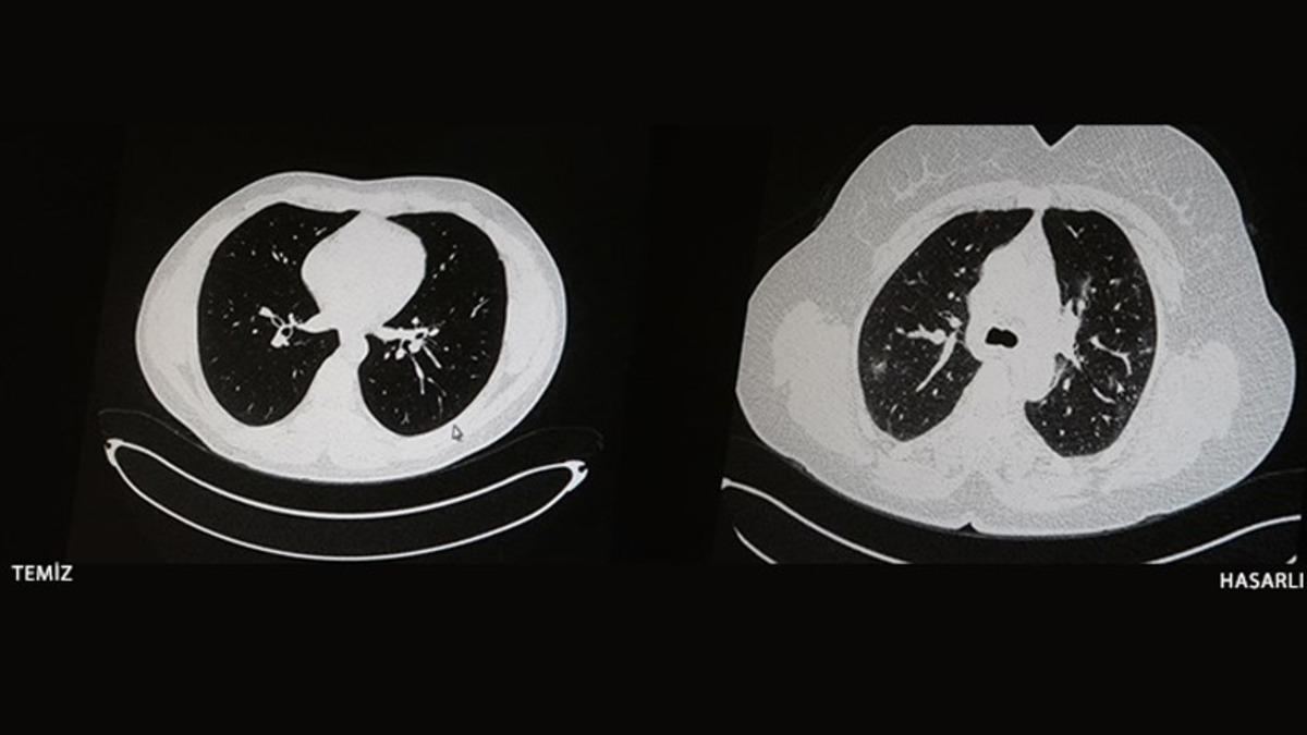 Aşı Olan ve Olmayan COVID-19 Hastalarının İbretlik Tomografi Görüntüleri