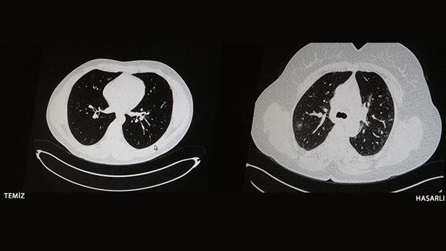 Aşı Olan ve Olmayan COVID-19 Hastalarının İbretlik Tomografi Görüntüleri