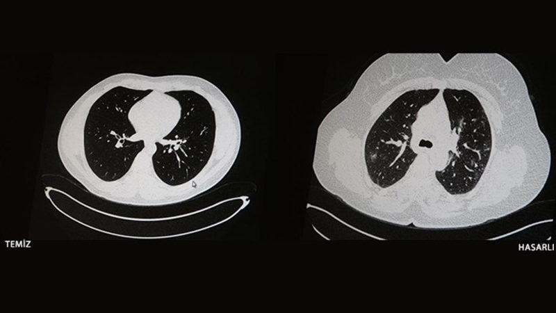 Aşı Olan ve Olmayan COVID-19 Hastalarının İbretlik Tomografi Görüntüleri