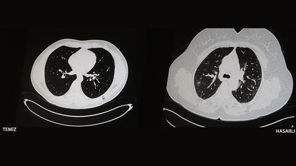 Buz Dağının Görünen Yüzü: Aşı Karşıtıyken Koronavirüse Yakalanarak Hayatını Kaybeden Bazı İnsanlar