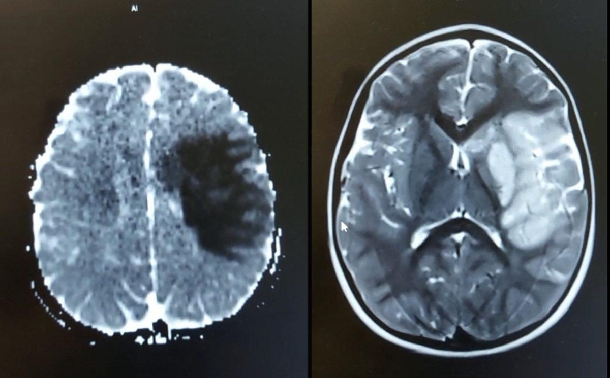 Buz Dağının Görünen Yüzü: Aşı Karşıtıyken Koronavirüse Yakalanarak Hayatını Kaybeden Bazı İnsanlar