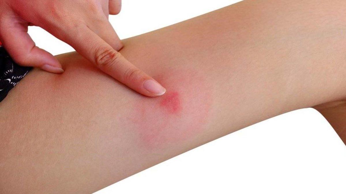 İstanbul’da Şimdi de ’Baldırsokan Sineği’ Paniği Başladı: Halk Sağlığını Tehdit Ediyor