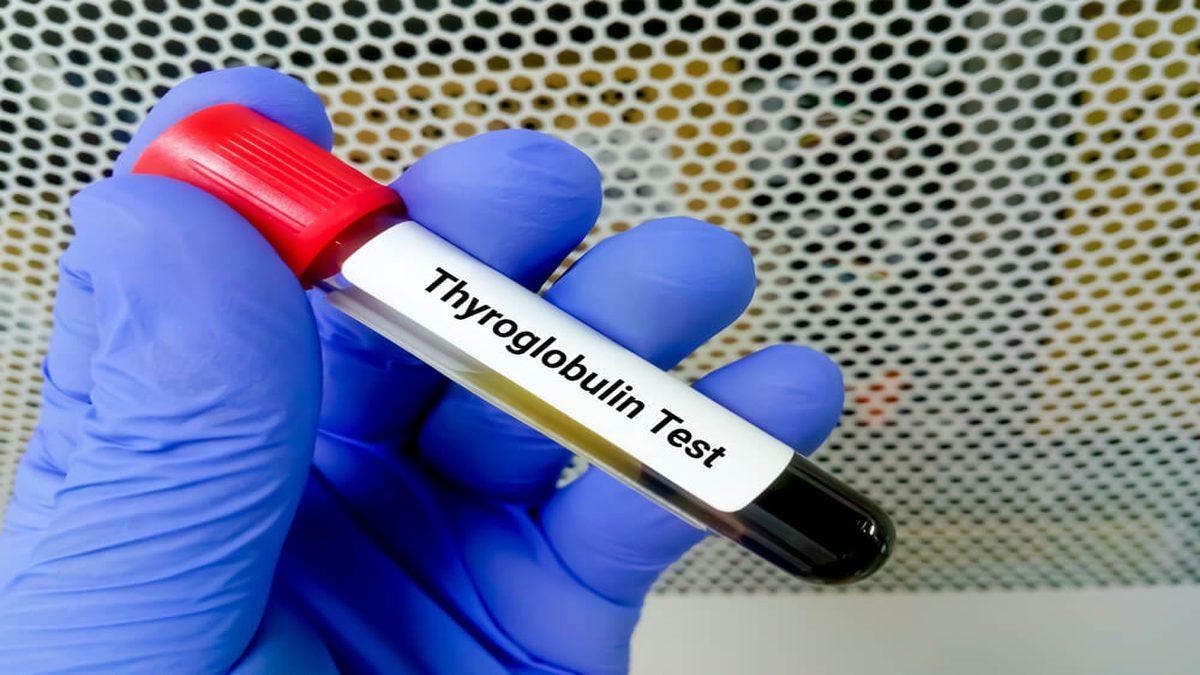 Kan Testlerinde Karşımıza Çıkan ’Anti Tiroglobulin Antikor’ Nedir, Yüksekliği ve Düşüklüğü Ne Anlama Gelir?
