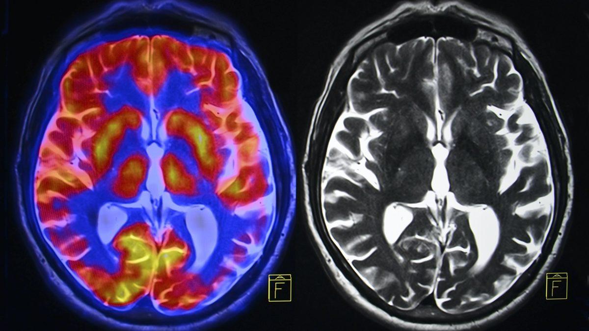 Şizofreni, Depresyon Gibi Psikolojik Bozuklukların 