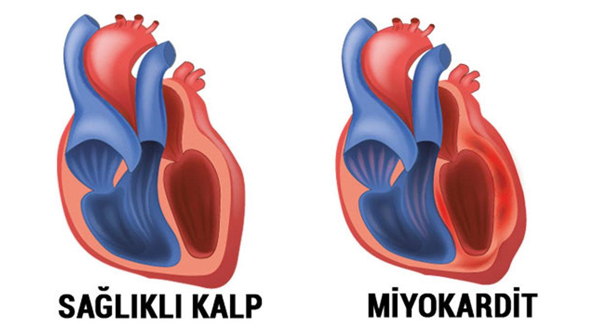 Moderna’nın Kalp İltihabına Neden Olma Oranının BioNTech’inkinden Yüksek Olduğu Açıklandı