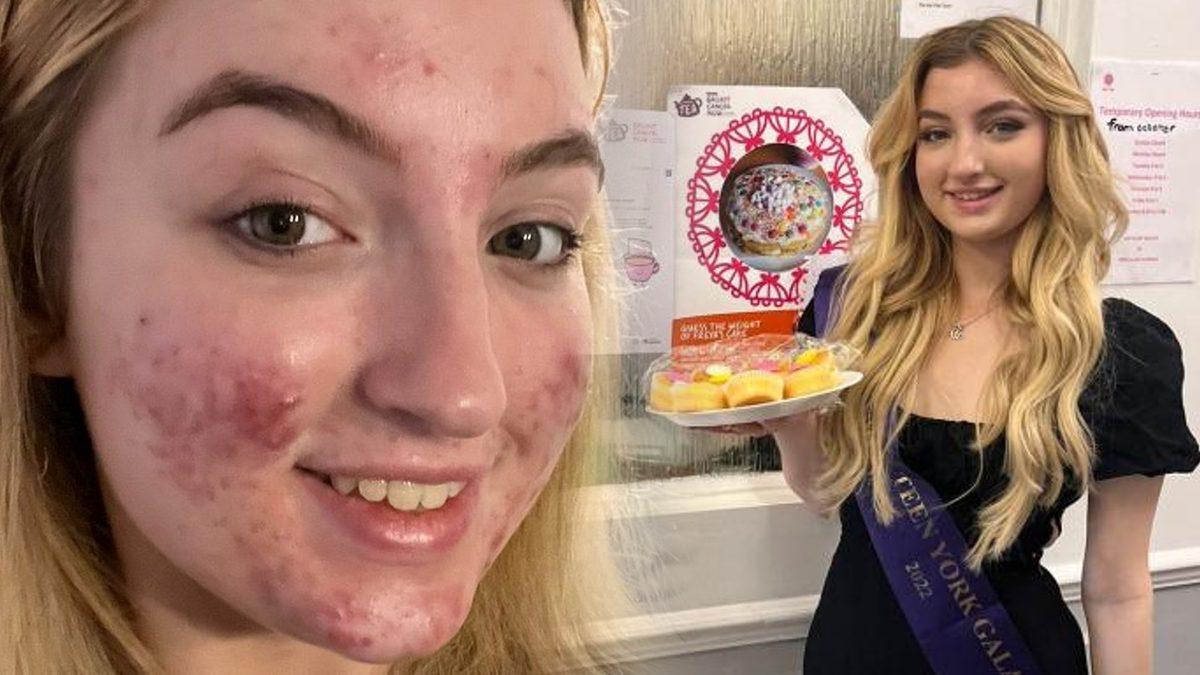 TikTok, Bir Kullanıcısını Sivilcelerini Gösterdiği İçin Banladı: Videolar ’Rahatsız Edici’ İçerik Olarak Damgalandı!