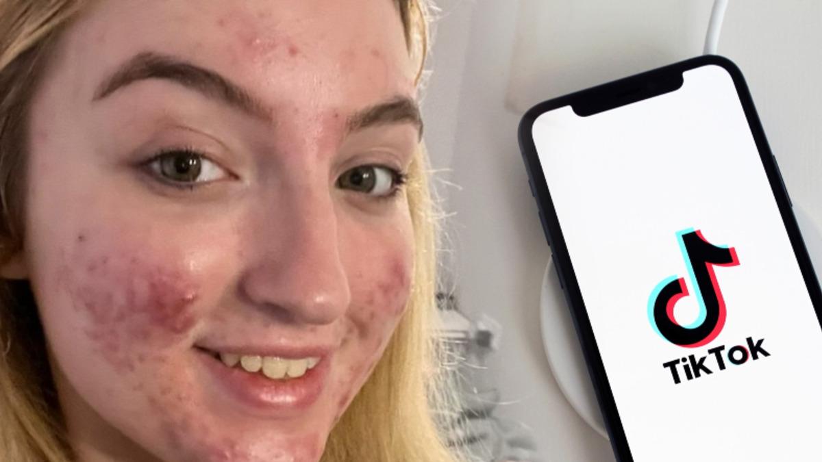 TikTok, Bir Kullanıcısını Sivilcelerini Gösterdiği İçin Banladı: Videolar ’Rahatsız Edici’ İçerik Olarak Damgalandı!