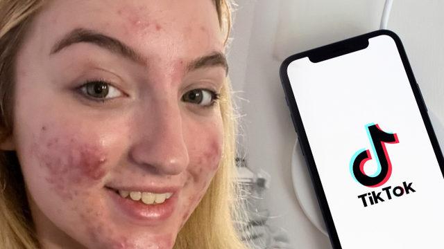 TikTok, Bir Kullanıcısını Sivilcelerini Gösterdiği İçin Banladı: Videolar ’Rahatsız Edici’ İçerik Olarak Damgalandı!