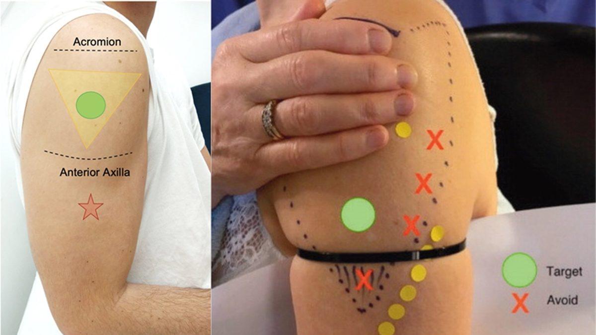 Aşı Neden Genellikle Kalçadan veya Başka Bir Yerden Değil de Omuzdan Yapılır?