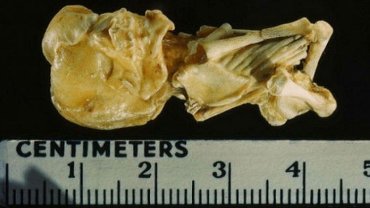 Anne Karnında Taşlaşmış Olan Gerçek Bir Bebeğe Bakıyorsunuz! Peki Bu Korkunç Vaka Nasıl Ortaya Çıkıyor?