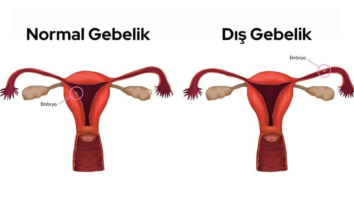 Anne Karnında Taşlaşmış Olan Gerçek Bir Bebeğe Bakıyorsunuz! Peki Bu Korkunç Vaka Nasıl Ortaya Çıkıyor?