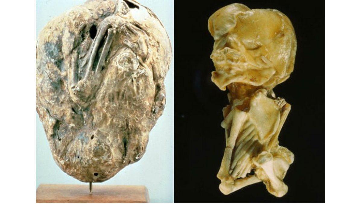 Anne Karnında Taşlaşmış Olan Gerçek Bir Bebeğe Bakıyorsunuz! Peki Bu Korkunç Vaka Nasıl Ortaya Çıkıyor?