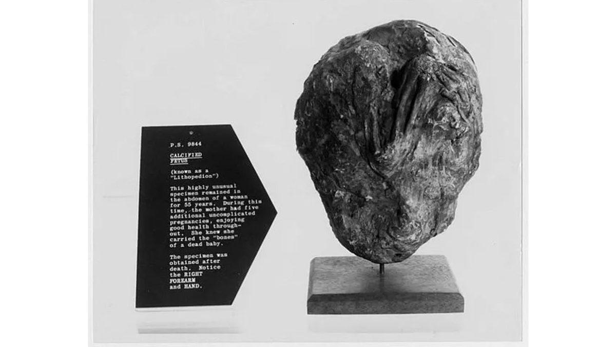 Anne Karnında Taşlaşmış Olan Gerçek Bir Bebeğe Bakıyorsunuz! Peki Bu Korkunç Vaka Nasıl Ortaya Çıkıyor?