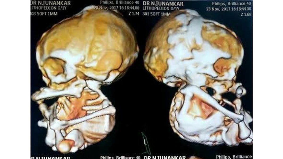 Anne Karnında Taşlaşmış Olan Gerçek Bir Bebeğe Bakıyorsunuz! Peki Bu Korkunç Vaka Nasıl Ortaya Çıkıyor?