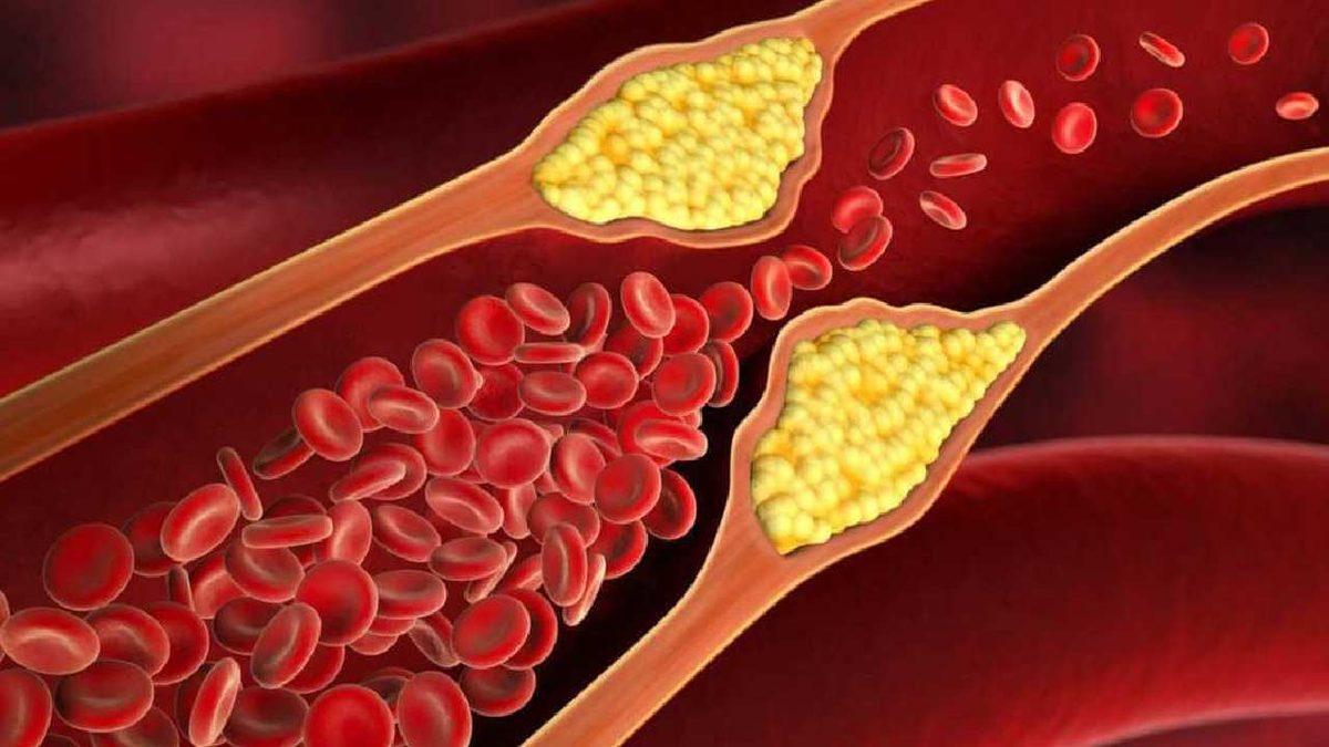 Halk Arasında ’Kötü Kolestrol’ Olarak Bilinen LDL Kolesterol Nedir, Düşüklüğü ve Yüksekliği Ne Anlama Gelir?