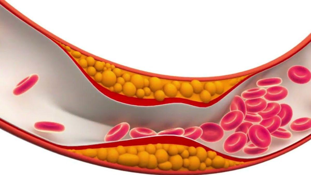 Halk Arasında ’Kötü Kolestrol’ Olarak Bilinen LDL Kolesterol Nedir, Düşüklüğü ve Yüksekliği Ne Anlama Gelir?