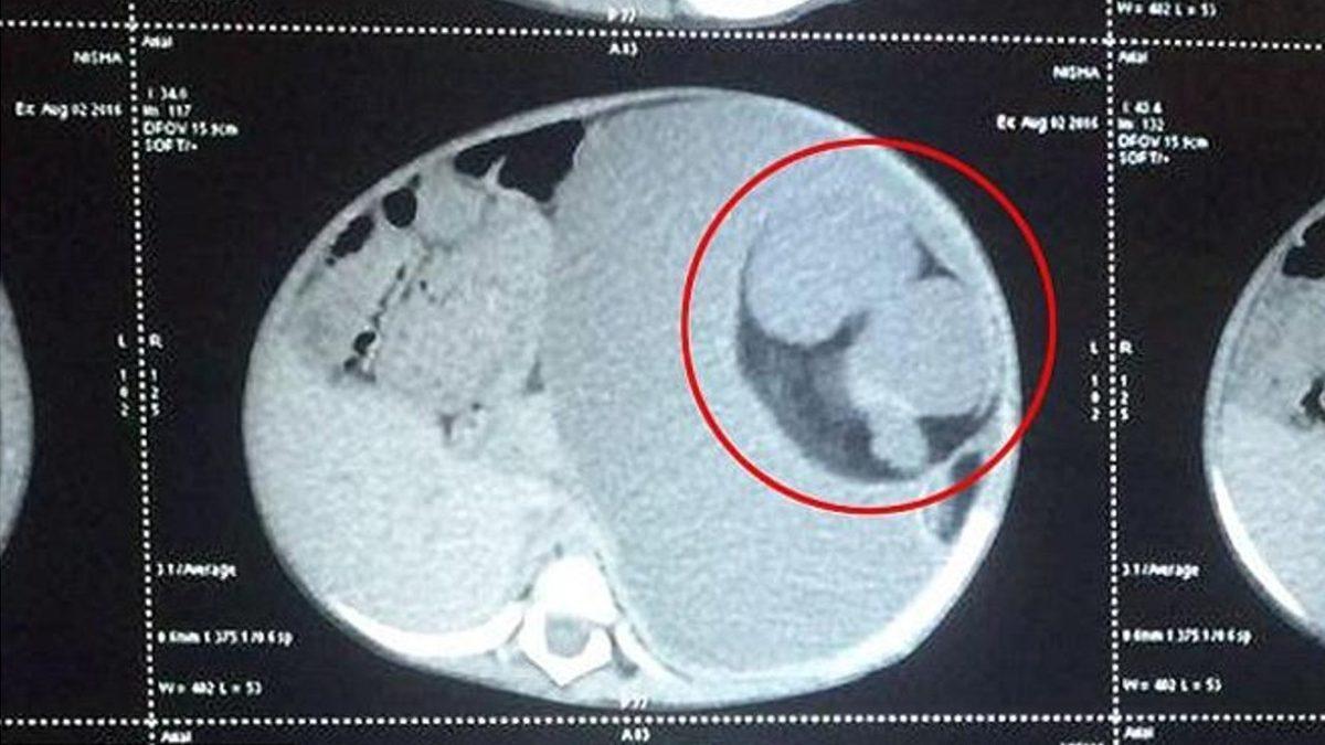 Doğmamış İkizinin Vücut Parçalarını İçinde Barındıran İnsanlar: Beyninde Kardeşini Taşıyan Bile Var!