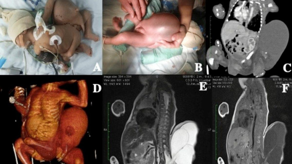 Doğmamış İkizinin Vücut Parçalarını İçinde Barındıran İnsanlar: Beyninde Kardeşini Taşıyan Bile Var!