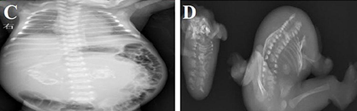 Doğmamış İkizinin Vücut Parçalarını İçinde Barındıran İnsanlar: Beyninde Kardeşini Taşıyan Bile Var!