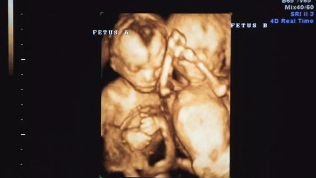 Doğmamış İkizinin Vücut Parçalarını İçinde Barındıran İnsanlar: Beyninde Kardeşini Taşıyan Bile Var!