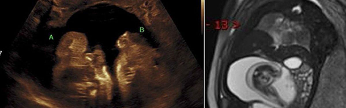 Doğmamış İkizinin Vücut Parçalarını İçinde Barındıran İnsanlar: Beyninde Kardeşini Taşıyan Bile Var!