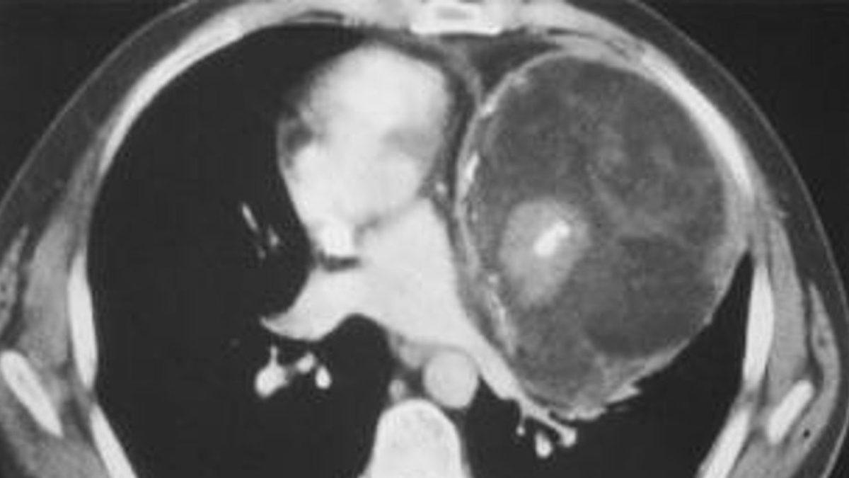 Doğmamış İkizinin Vücut Parçalarını İçinde Barındıran İnsanlar: Beyninde Kardeşini Taşıyan Bile Var!