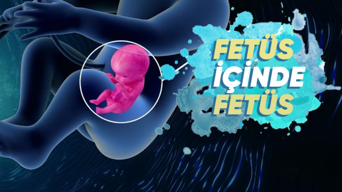 Doğmamış İkizinin Vücut Parçalarını İçinde Barındıran İnsanlar: Beyninde Kardeşini Taşıyan Bile Var!