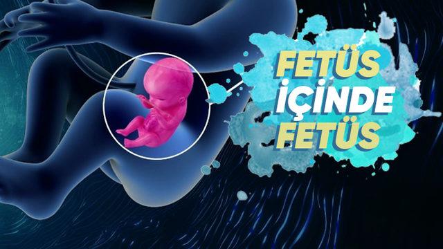 Doğmamış İkizinin Vücut Parçalarını İçinde Barındıran İnsanlar: Beyninde Kardeşini Taşıyan Bile Var!