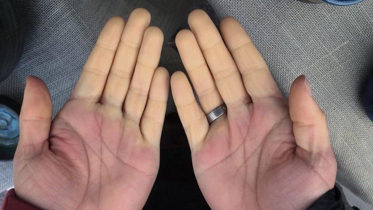 Kangrene Bile Sebep Olabilen ve Az Bilinmesine Rağmen Yaygın Görülen Bir Hastalık: Raynaud Sendromu