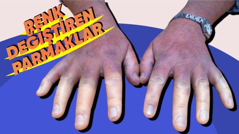 Kangrene Bile Sebep Olabilen ve Az Bilinmesine Rağmen Yaygın Görülen Bir Hastalık: Raynaud Sendromu