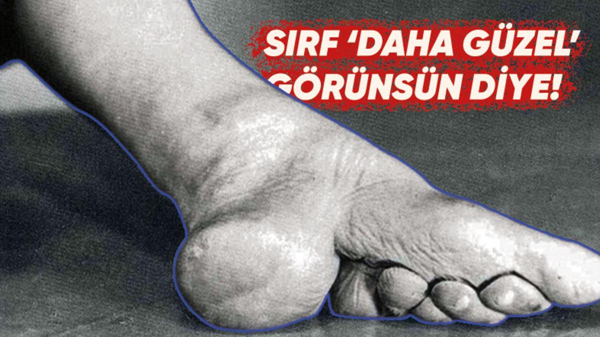 Bir Tür Ayak Fetişi Olarak Görülen ve Pek Çok Rahatsızlığa Yol Açan Bin Yıllık Korkunç Çin Geleneği: Lotus Ayak