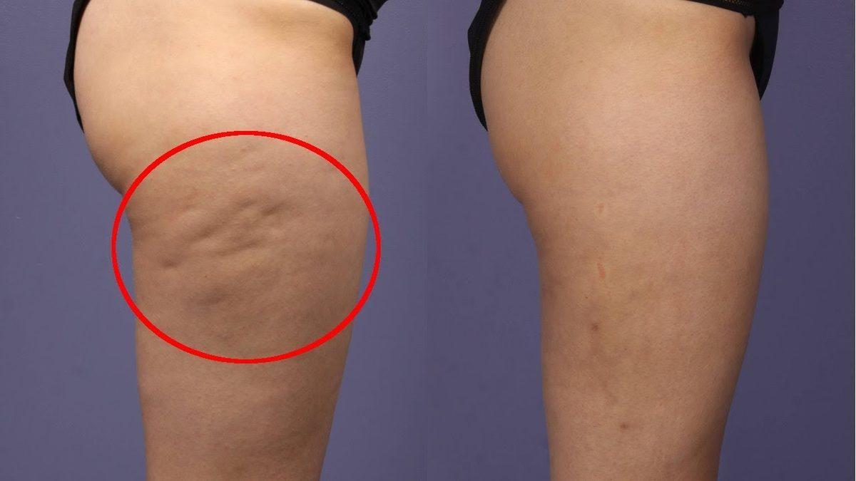 Hanımların Dikkatine: Selülit Neden Olur, Gidermek İçin Ne Yapmak Gerekir?