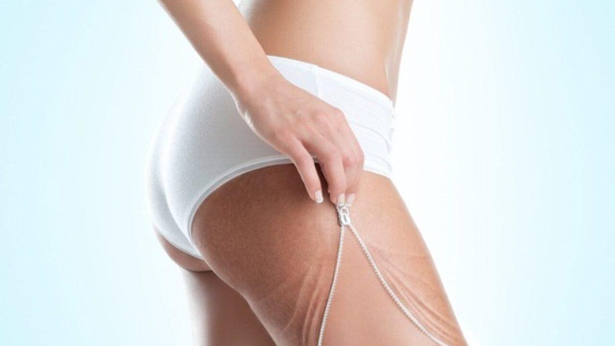 Hanımların Dikkatine: Selülit Neden Olur, Gidermek İçin Ne Yapmak Gerekir?