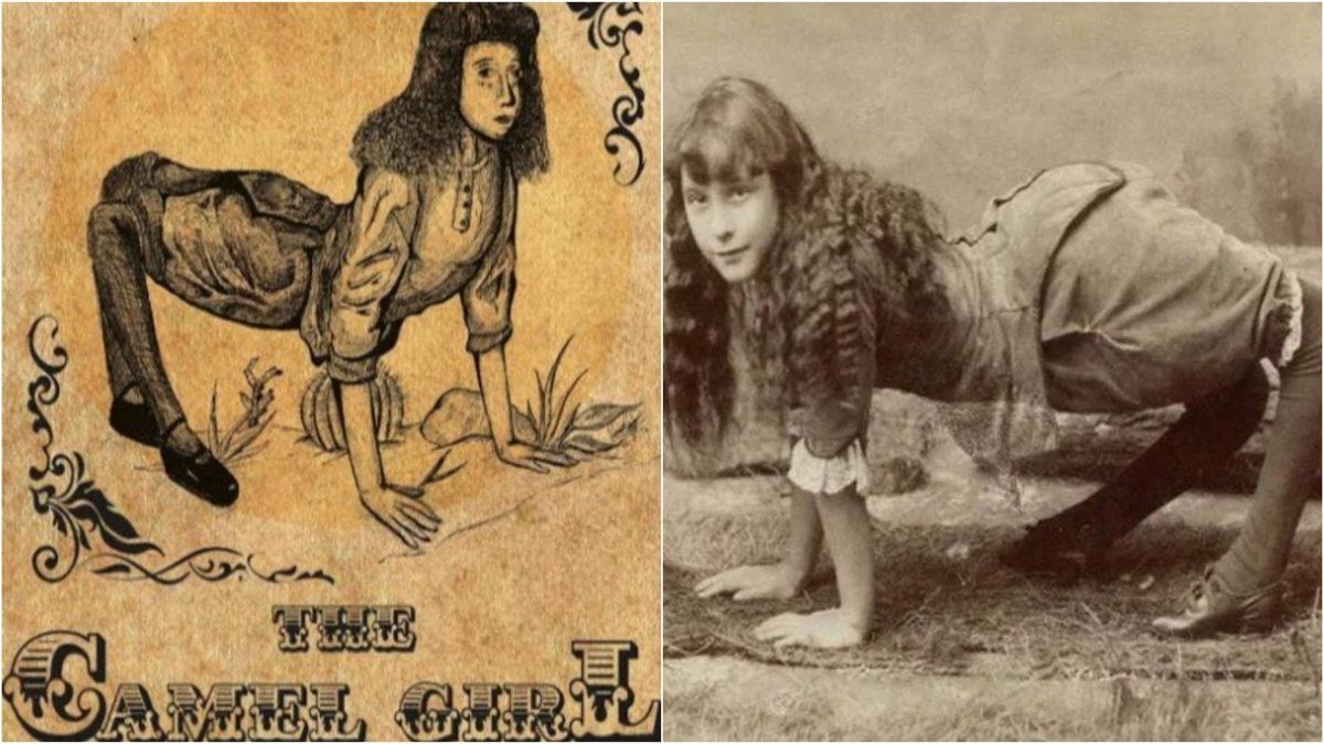 Ayakları Ters Olarak Doğan ve 