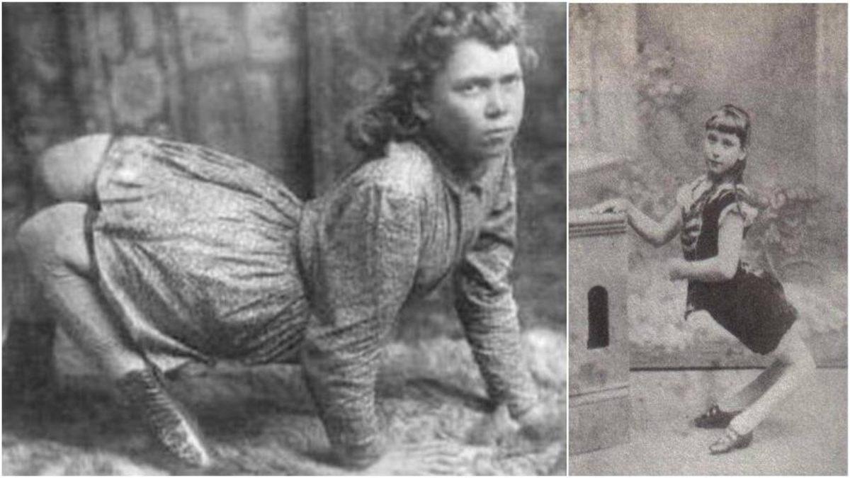 Ayakları Ters Olarak Doğan ve 