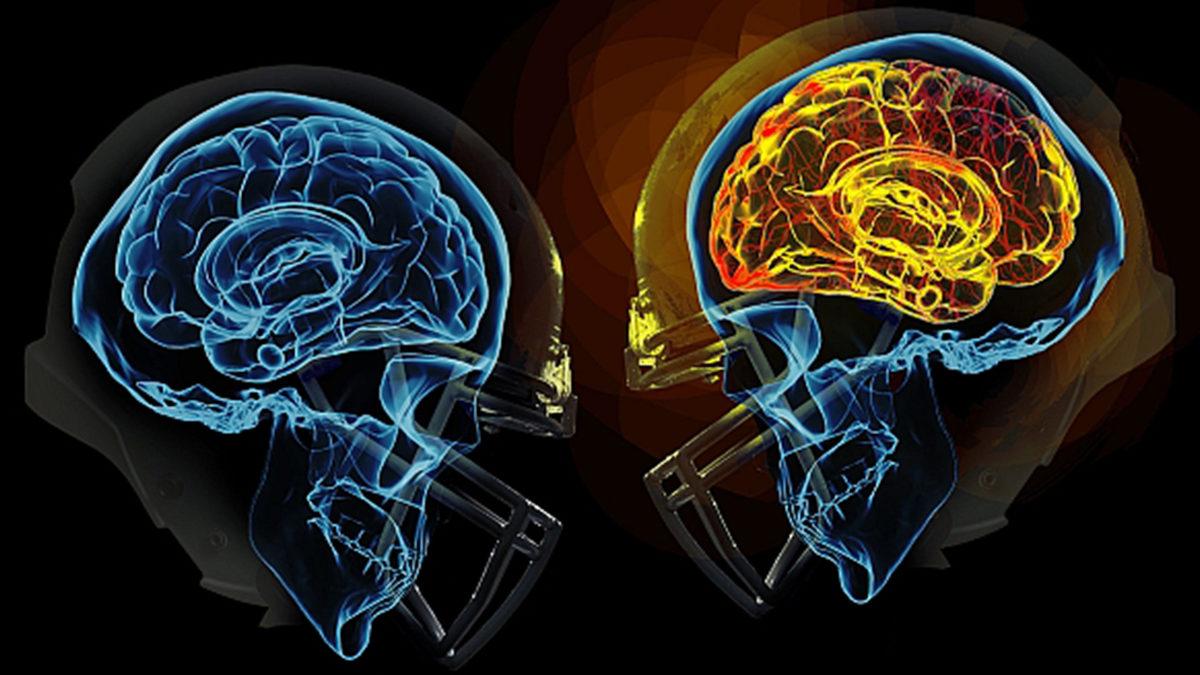 Araştırmacılar, Beyin Sarsıntısının Kalıcı Duyma Bozukluğuna Yol Açabileceğini Keşfetti