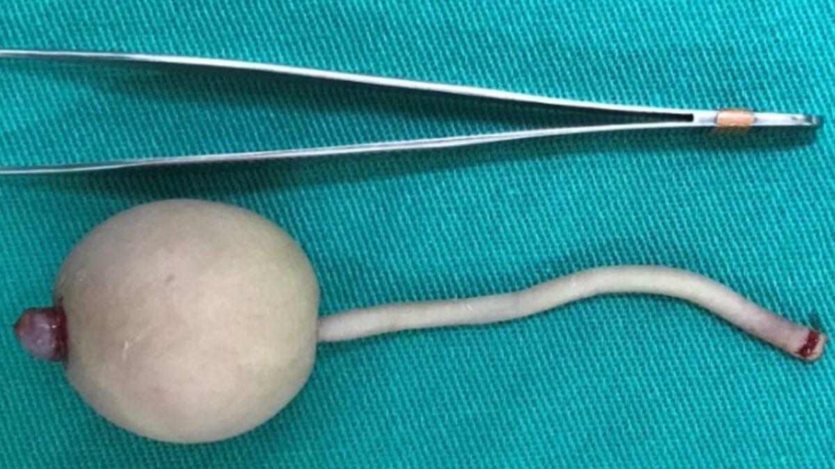 Brezilya’da Bir Bebek, 12 cm Uzunluğunda Bir Kuyrukla Dünyaya Geldi