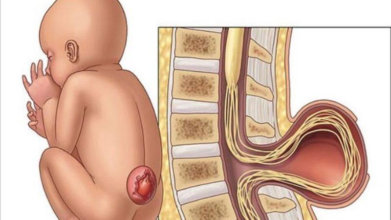 Brezilya’da Bir Bebek, 12 cm Uzunluğunda Bir Kuyrukla Dünyaya Geldi