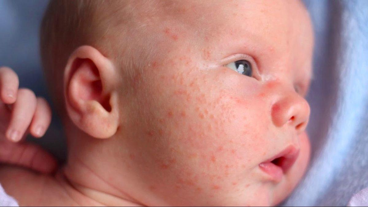 Cildimizde Kızarıklık ve Kaşıntıya Neden Olan ’Atopik Dermatit Egzama’ Nedir, Nasıl Geçer?