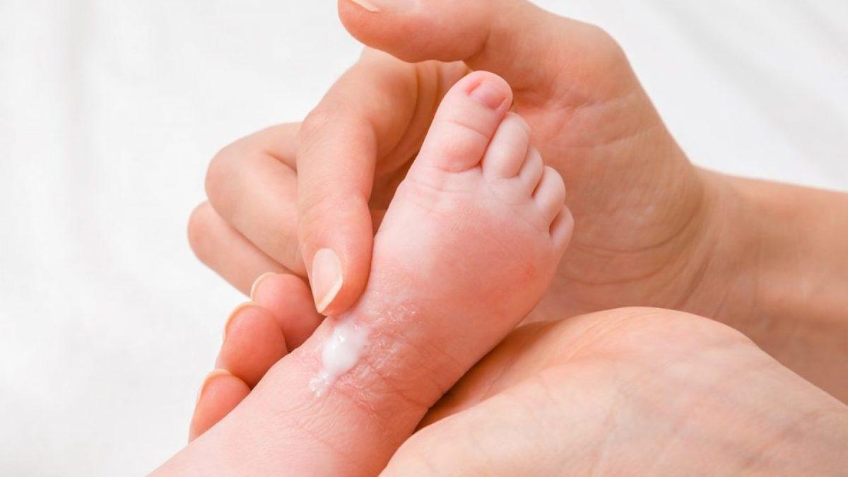 Cildimizde Kızarıklık ve Kaşıntıya Neden Olan ’Atopik Dermatit Egzama’ Nedir, Nasıl Geçer?