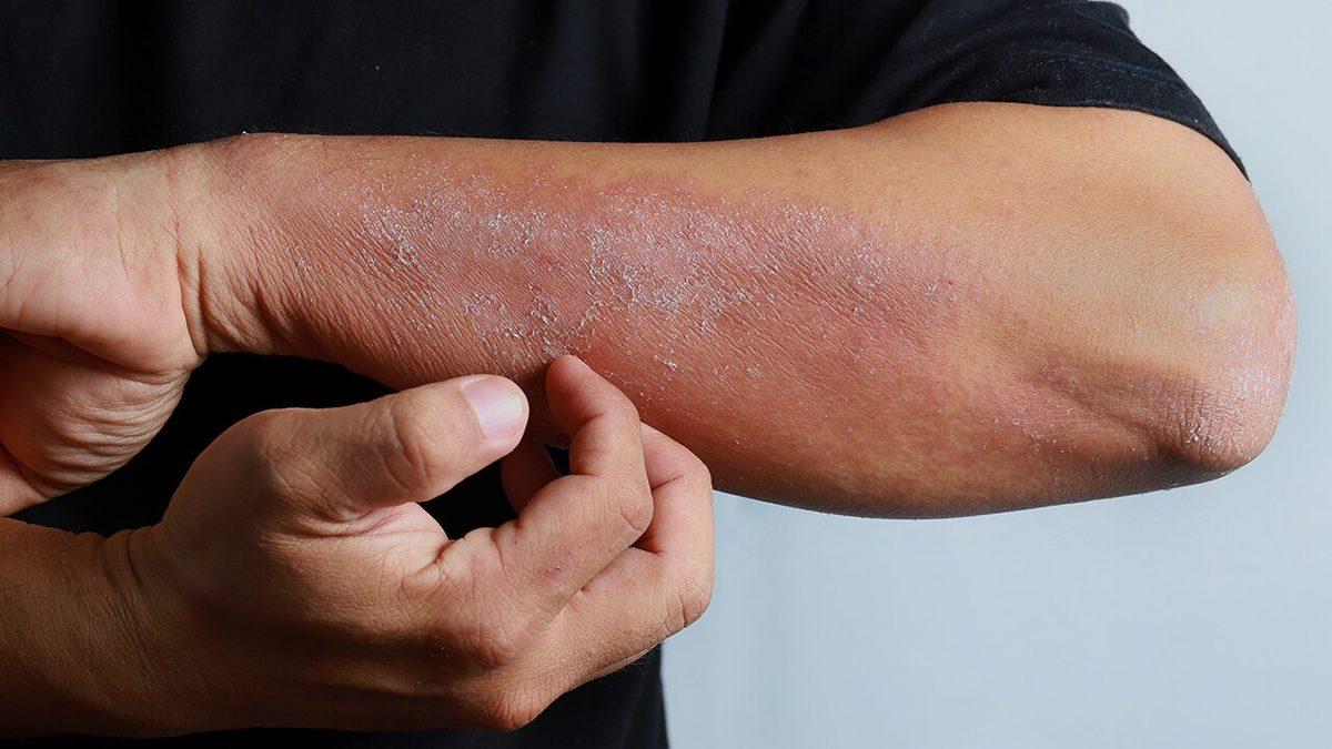 Cildimizde Kızarıklık ve Kaşıntıya Neden Olan ’Atopik Dermatit Egzama’ Nedir, Nasıl Geçer?