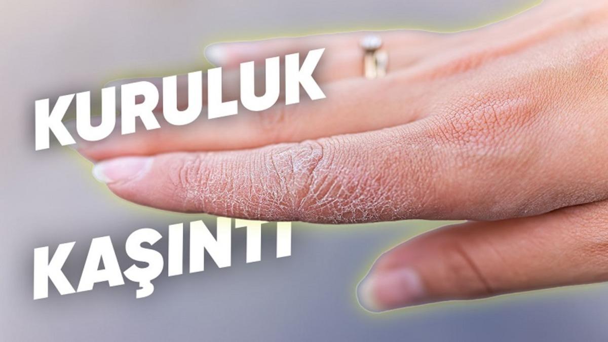 Cildimizde Kızarıklık ve Kaşıntıya Neden Olan ’Atopik Dermatit Egzama’ Nedir, Nasıl Geçer?