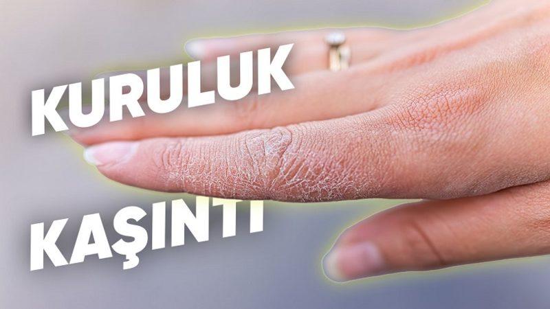 Cildimizde Kızarıklık ve Kaşıntıya Neden Olan ’Atopik Dermatit Egzama’ Nedir, Nasıl Geçer?