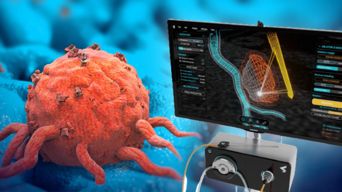 Kanser Tedavisi İçin ’Akıllı İğne’ Geliştiriliyor: Vücudun Herhangi Bir Yerindeki Tümör Yok Edilebilecek!