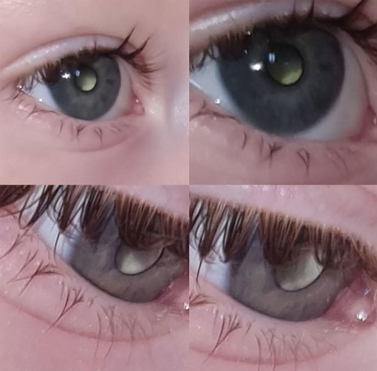 Göz Bebeği Bir Anda Beyaza Dönen 2 Yaşındaki Çocukta Son Derece Nadir Bir Hastalık Keşfedildi