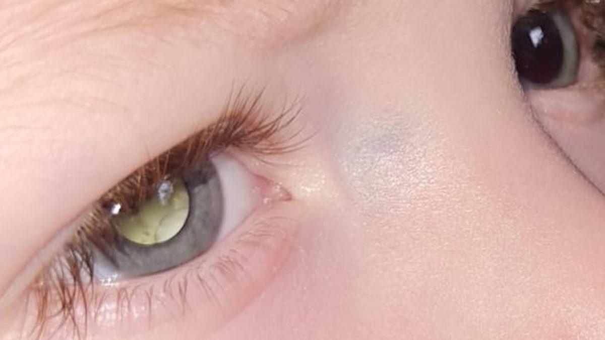 Göz Bebeği Bir Anda Beyaza Dönen 2 Yaşındaki Çocukta Son Derece Nadir Bir Hastalık Keşfedildi